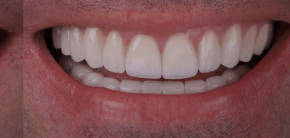 After image
